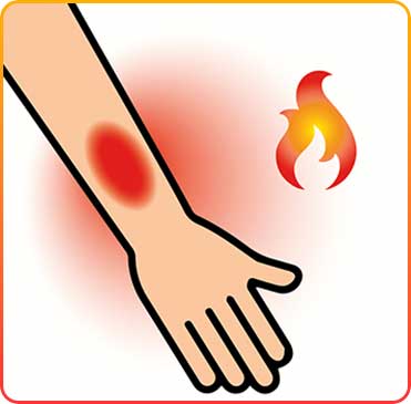 Flacon anti-brûlure hydrogel 118 ml - brûlure